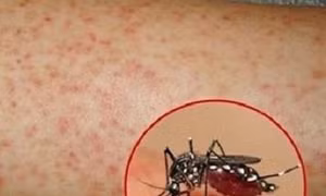 Số ca mắc sốt xuất huyết ở Đắk Lắk tăng hơn 40 lần so với cùng kỳ 2018