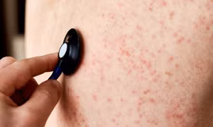 Quảng Nam triển khai nhanh giải pháp phòng, chống dịch sốt phát ban