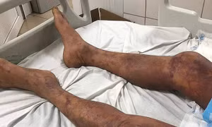 Giết mổ và ăn thịt lợn ốm, người đàn ông sốc nhiễm khuẩn, suy đa tạng
