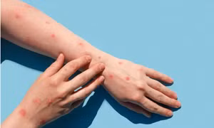 Xuất hiện ca bệnh đậu mùa khỉ đầu tiên tại Đồng Nai