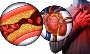 Nguy cơ mắc bệnh tim liên quan hạt vi nhựa bám trong động mạch