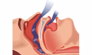 Xác định mối liên hệ giữa chứng ngáy ngủ và huyết áp cao