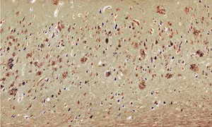 Phát hiện mới có thể cải thiện hiệu quả của thuốc điều trị bệnh Alzheimer