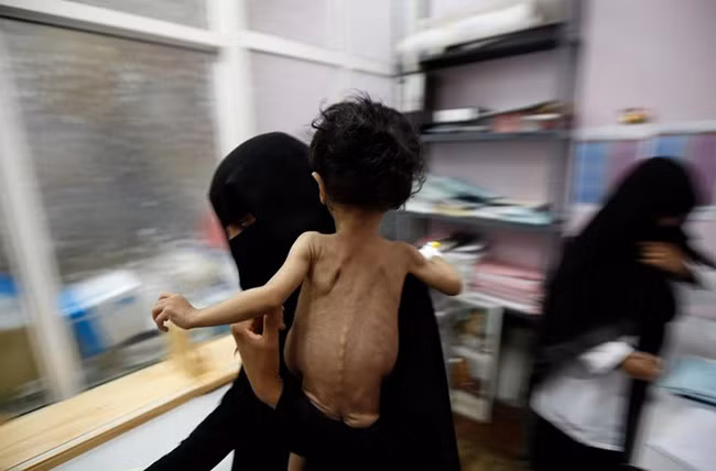 Ám ảnh những đứa trẻ “da bọc xương” tại vùng chiến sự Yemen ảnh 5