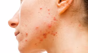 Người mặt mụn có xu hướng trẻ lâu