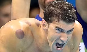 Cơ thể đầy vết bầm giác hơi của hàng loạt VĐV Olympic