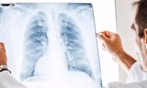 Vaccine ADN đường mũi mở hướng mới trong điều trị lao