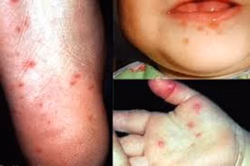 Bệnh tay chân miệng thường gặp ở trẻ dưới 5 tuổi ảnh 1
