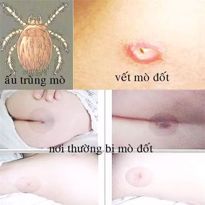 Bệnh sốt mò dễ chẩn đoán nhầm ảnh 1
