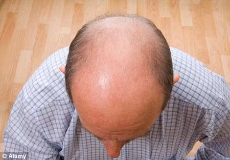 Đàn ông hói đầu dễ bị ung thư tiền liệt tuyến? ảnh 1