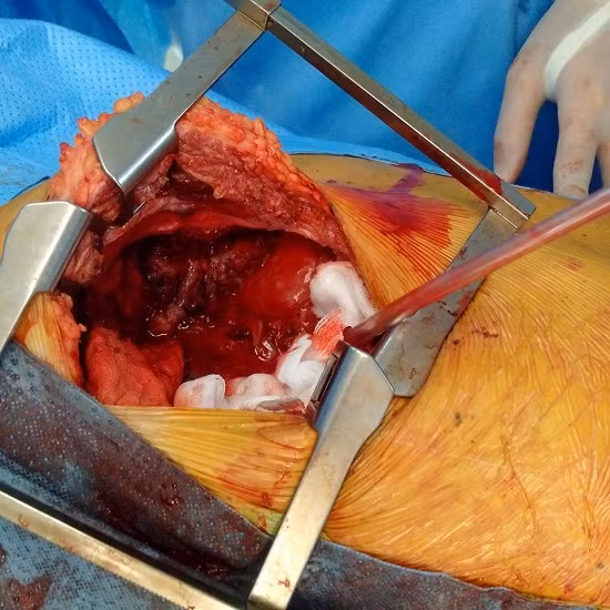 Phẫu thuật cắt khối u quái khổng lồ gần 7 kg ảnh 1