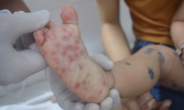 Thái Nguyên: Giám sát chặt chẽ, không để bệnh tay - chân - miệng lây lan trong trường học