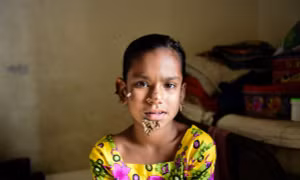 Mắc bệnh lạ, bé gái người Bangladesh 'nẩy chồi cây' trên mặt