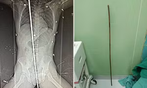 Công nhân xây dựng bị sét đánh, thanh thép dài 2m đâm xuyên người vẫn sống sót kỳ diệu