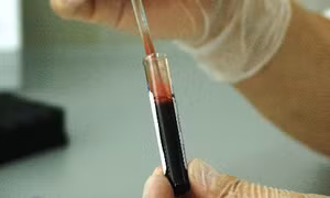 Xét nghiệm máu siêu nhạy của Johns Hopkins phát hiện ADN ung thư sớm 3 năm