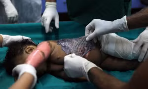 Độc đáo phương pháp chữa bỏng bằng da cá rô phi