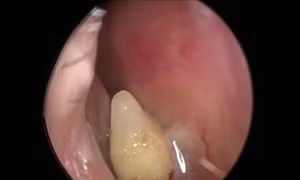 Kỳ lạ răng mọc trong mũi gây chảy máu cam suốt hàng chục năm