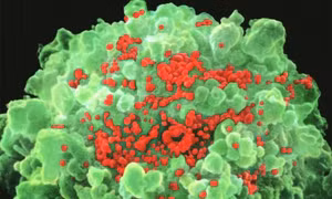 Chấn động: Vaccine AIDS cứu 5 bệnh nhân ‘sạch’ HIV trong 7 tháng