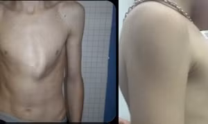 Bước tiến mới trong điều trị ngực lồi cho bệnh nhi 