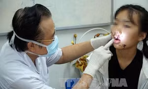 Ngã vào cửa kính lớp học, một bé gái bị tổn thương nghiêm trọng ở mặt 
