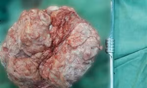 Bóc tách thành công khối u xơ nặng 4 kg cho nữ bệnh nhân