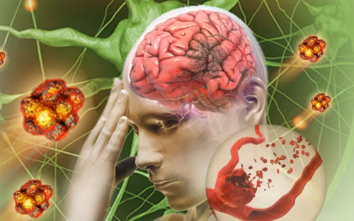 Đau đầu làm tăng sinh vô số gốc tự do, tăng nguy cơ đột quỵ. Nguồn: suckhoedoisong.vn