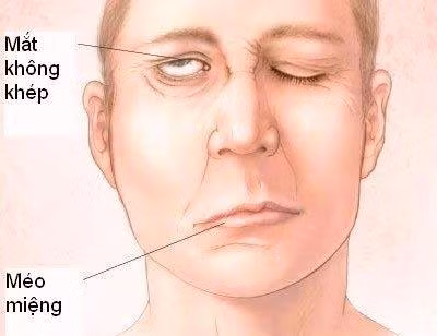 Cẩn thận biến dạng khuôn mặt vì cơn gió lạnh đầu mùa