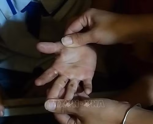 Lấy mẫu phân tích, xác định bệnh lý để sớm có phương án điều trị bệnh ngứa chân tay cho học sinh ở huyện Tủa Chùa 