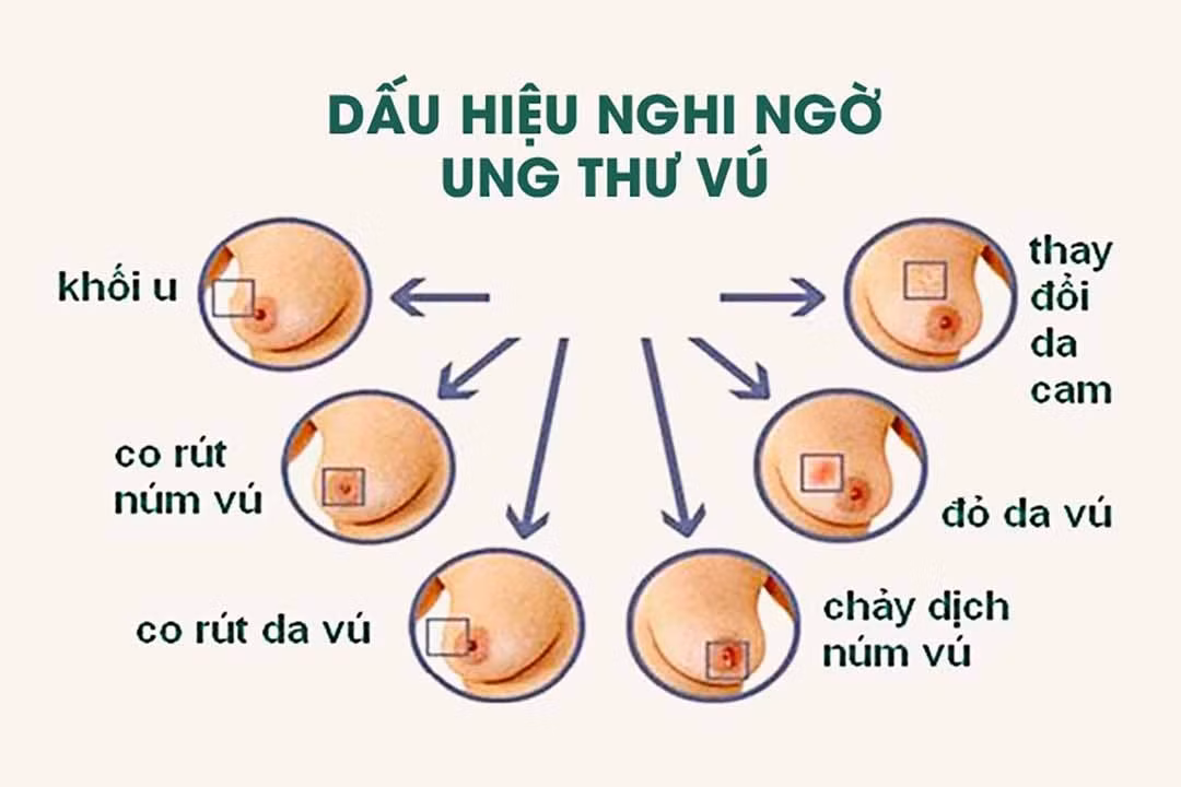 Ung thư vú là nguyên nhân gây tử vong hàng đầu do ung thư ở phụ nữ với 1,7 triệu người mắc và nửa triệu người chết hàng năm. Ảnh :benhvien108.vn 