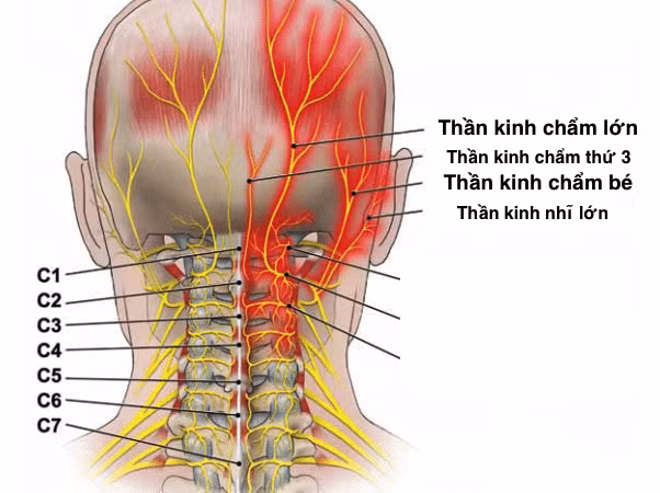 Đau dây thần kinh chẩm là một nguyên nhân phổ biến gây đau đầu. Ảnh : vinmec.com 