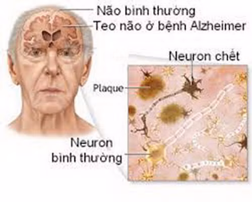 Những điều cần biết về bệnh Alzheimer