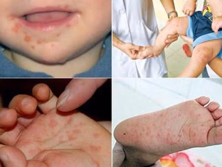 Đồng Tháp: Khuyến cáo các biện pháp phòng ngừa bệnh tay chân miệng