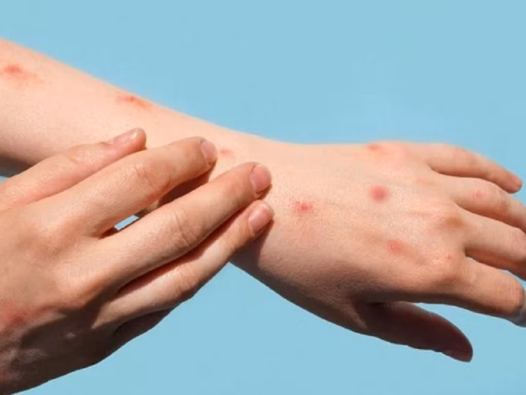 Tăng cường điều trị ca mắc đậu mùa khỉ, không để xảy ra lây nhiễm chéo