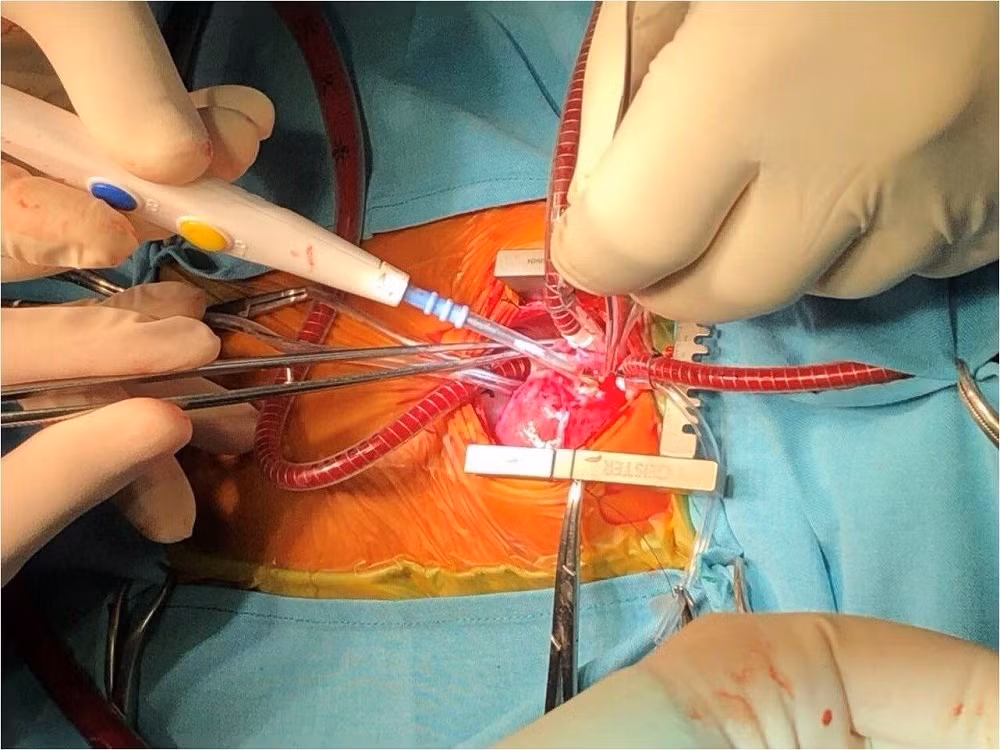 Nghiên cứu mới giúp điều trị rối loạn nhịp tim