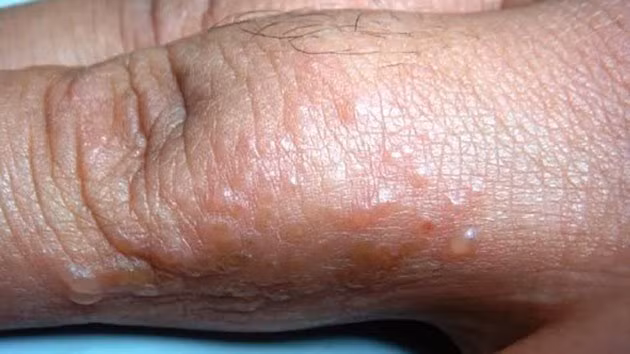 Quảng Ngãi: Xử lý bệnh ghẻ đang lây lan trong thôn có đông đồng bào dân tộc Cor