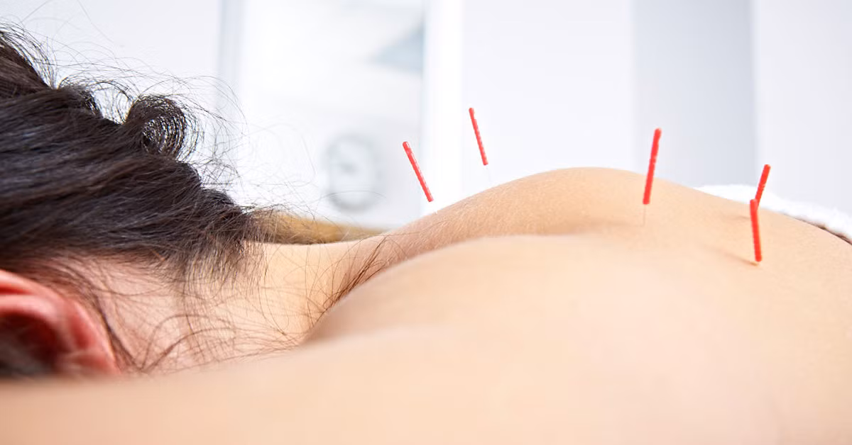 Châm cứu có thể giúp giảm đau trong phẫu thuật ung thư