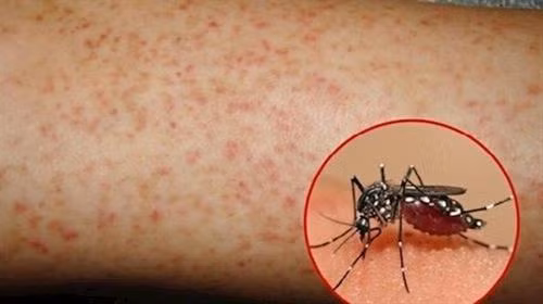 Giám sát chặt chẽ, phát hiện, xử lý kịp thời các ổ bệnh sốt xuất huyết ở Trà Vinh