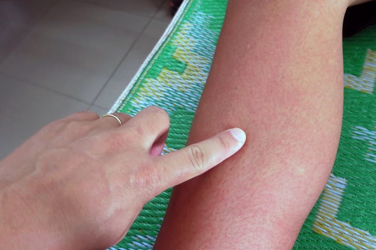 Sốt xuất huyết tiếp tục gia tăng, người dân chủ động các biện pháp phòng bệnh