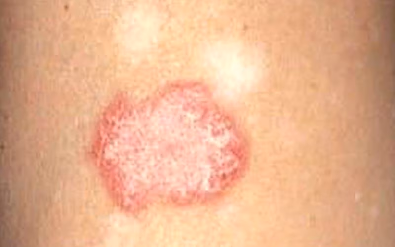 Tìm ra phương pháp mới điều trị lupus ban đỏ