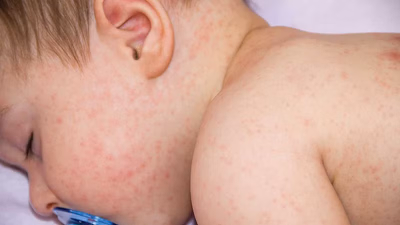 Phát hiện mới về việc ngăn ngừa nguy cơ dị ứng ở trẻ em