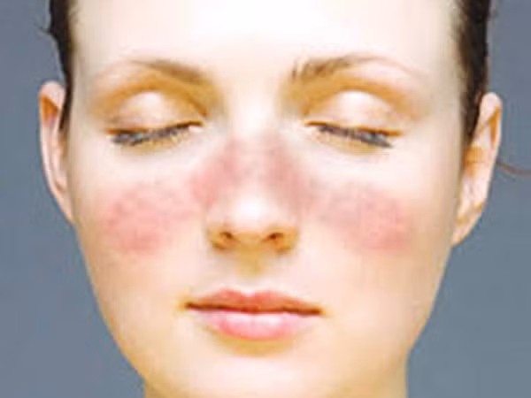 Phát hiện gene gây bệnh lupus ban đỏ