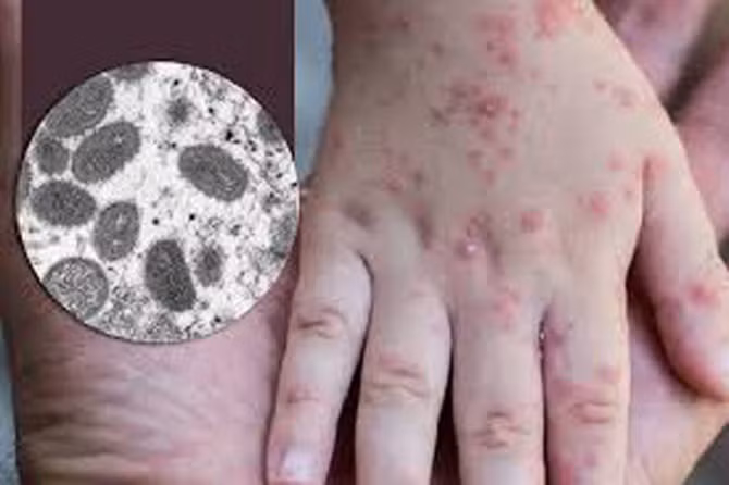 Bến Tre phát hiện ca bệnh đậu mùa khỉ đầu tiên