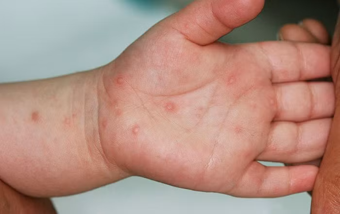 Bác sĩ Khoa Nhi - Bệnh viên Đa khoa vùng Tây Nguyên thăm khám cho bệnh nhi bị tay chân miệng. Ảnh: vov.vn