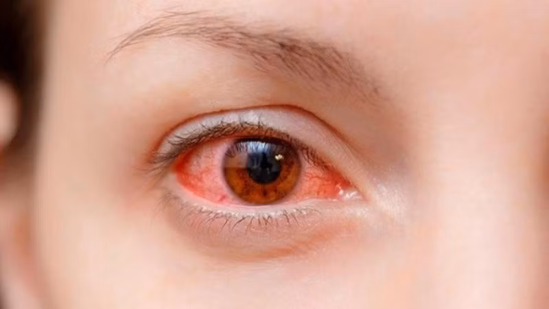 Đau mắt đỏ biến chứng có thể ảnh hưởng tới thị lực lâu dài của trẻ