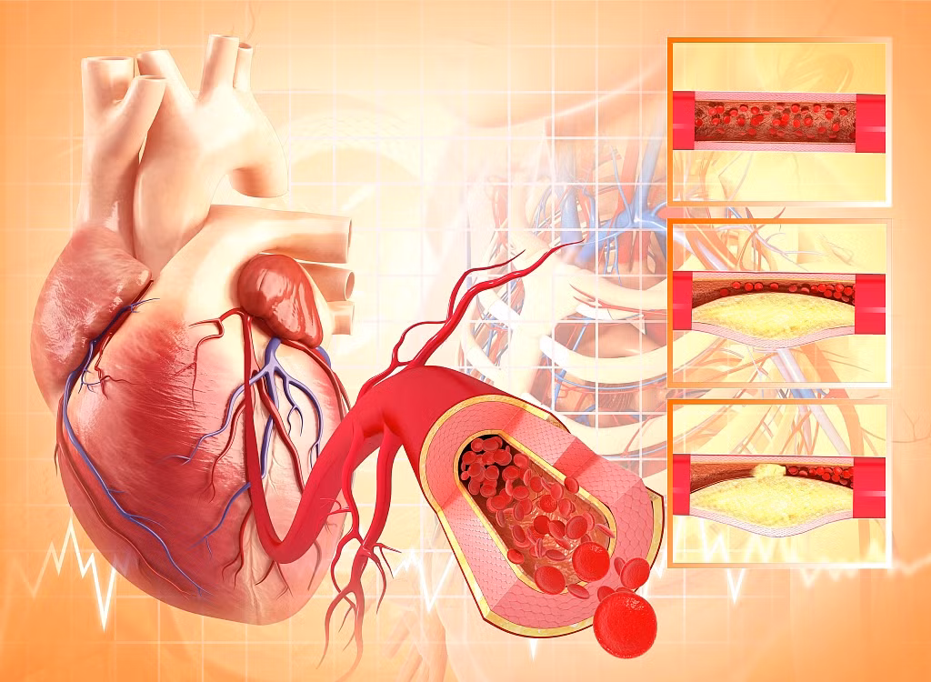 Đột biến gene tạo máu liên quan đến bệnh tim