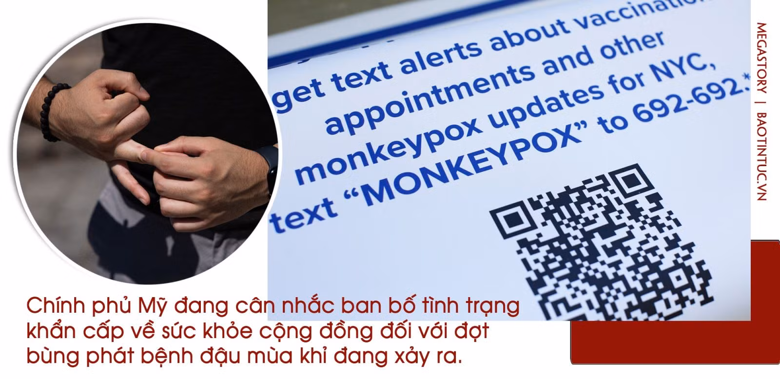Cảnh giác với bệnh đậu mùa khỉ ảnh 9
