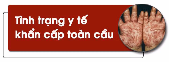 Cảnh giác với bệnh đậu mùa khỉ ảnh 1