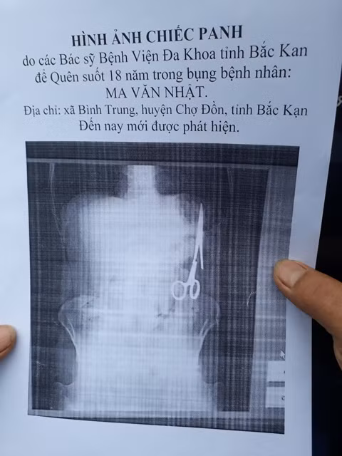 Bắc Kạn: Xác minh việc bác sỹ để quên kéo trong bụng bệnh nhân 18 năm ảnh 1