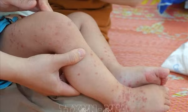 Tăng cường phòng dịch, hạn chế bệnh chuyển nặng