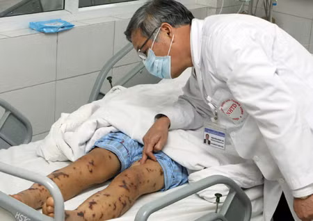 Ca viêm não mô cầu đầu tiên ở miền Bắc ảnh 1